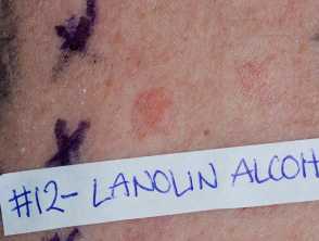 Positive patch test presenting with red macules on skin where lanolin patch was placed