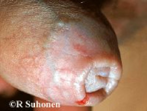 Penile lichen sclerosus