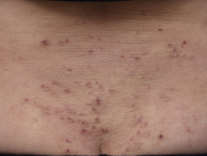 Scratched atopic eczema
