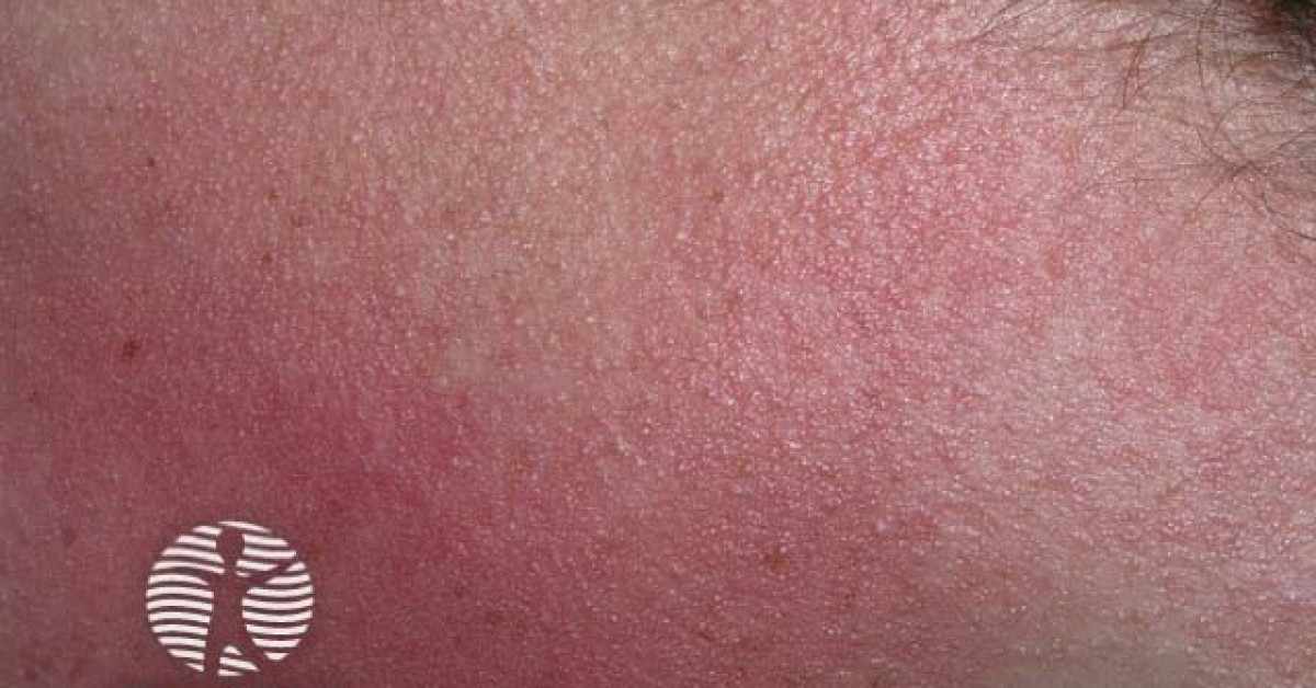 Keratosis Pilaris Image