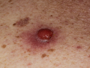 Amelanotic melanoma*