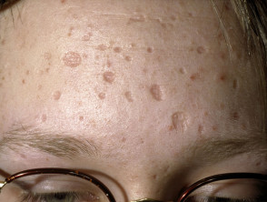 Chickenpox scars