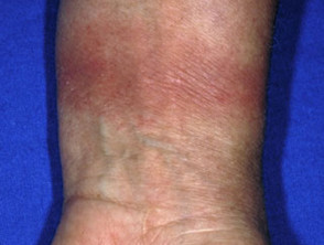 Contact allergic dermatitis of the arms and legs