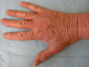 Hand dermatitis due to contact allergy to thiuram in rubber gloves