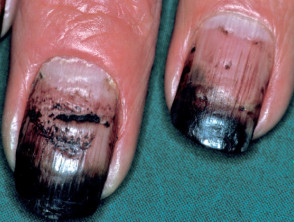 Dithranol stained nail