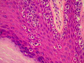 Pathology of melanoma