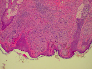 Pathology of dermal naevus