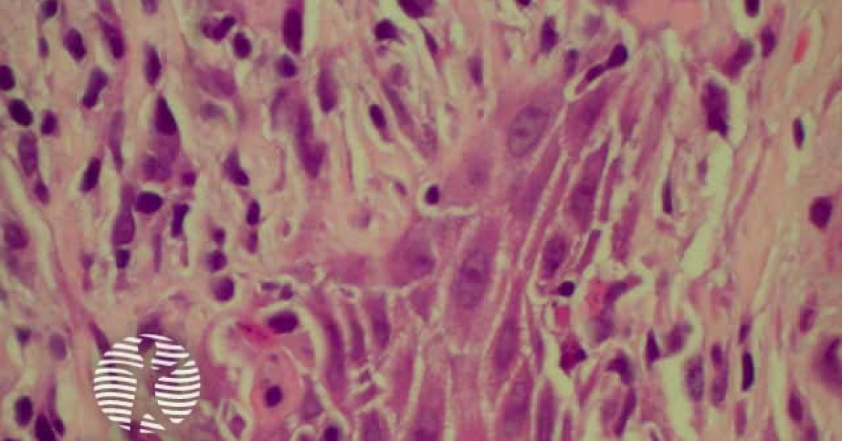 Lichen Planus Image