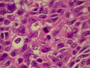 Pathology of Superficial spreading melanoma 