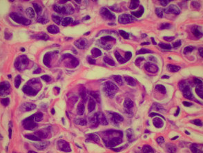 Pathology of Superficial spreading melanoma 