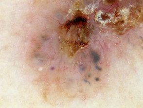 Dermoscopy of basal cell carcinoma showing blue clods