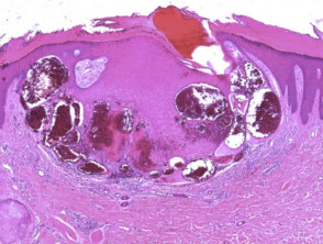 Histopathology of haemangioma