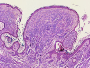 Histopathology of melanocytic naevus