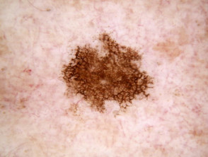 Dermatoscopic image of ink spot lentigo