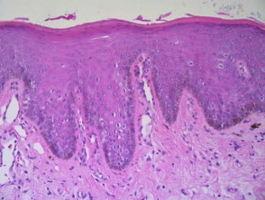 The histologic basis for reticular / branched lines in dermatoscopy