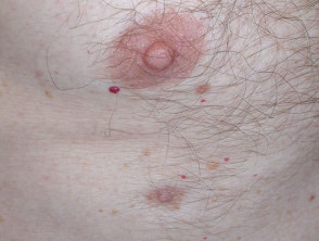 Accessory nipple