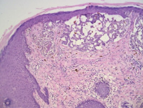 Histopathology of nests of pigmented melanocytes