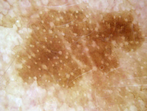 Dermatoscopy of solar lentigo