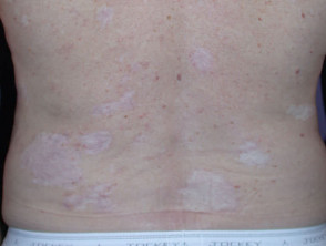 Cryotherapy marks
