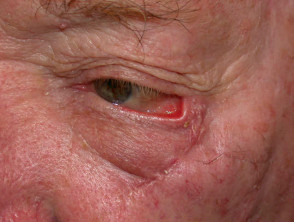 Ectropion due to excision