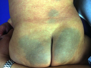 Mongolian spot. Dermal melanocytosis