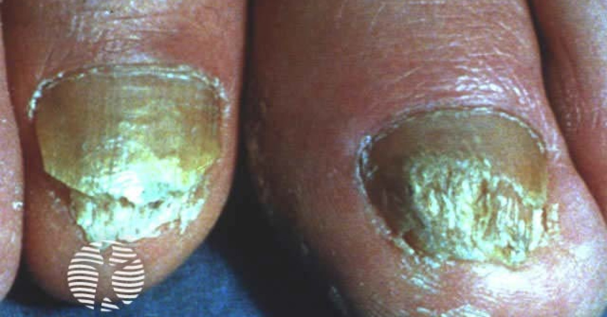 DermNet Nail Psoriasis Image