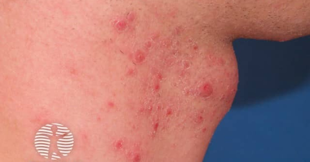 Pseudofolliculitis Barbae Image