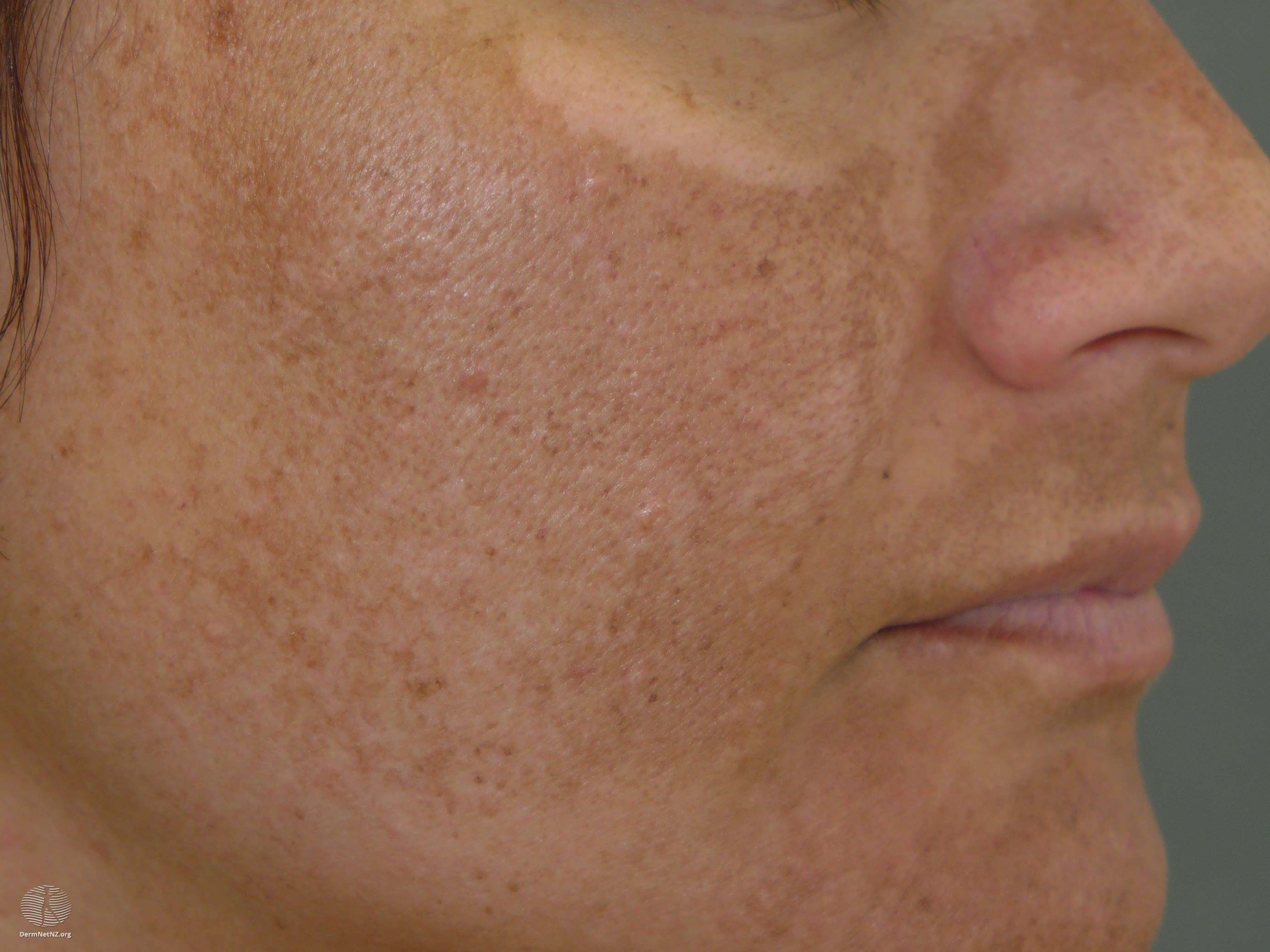 Blotchy facial rash