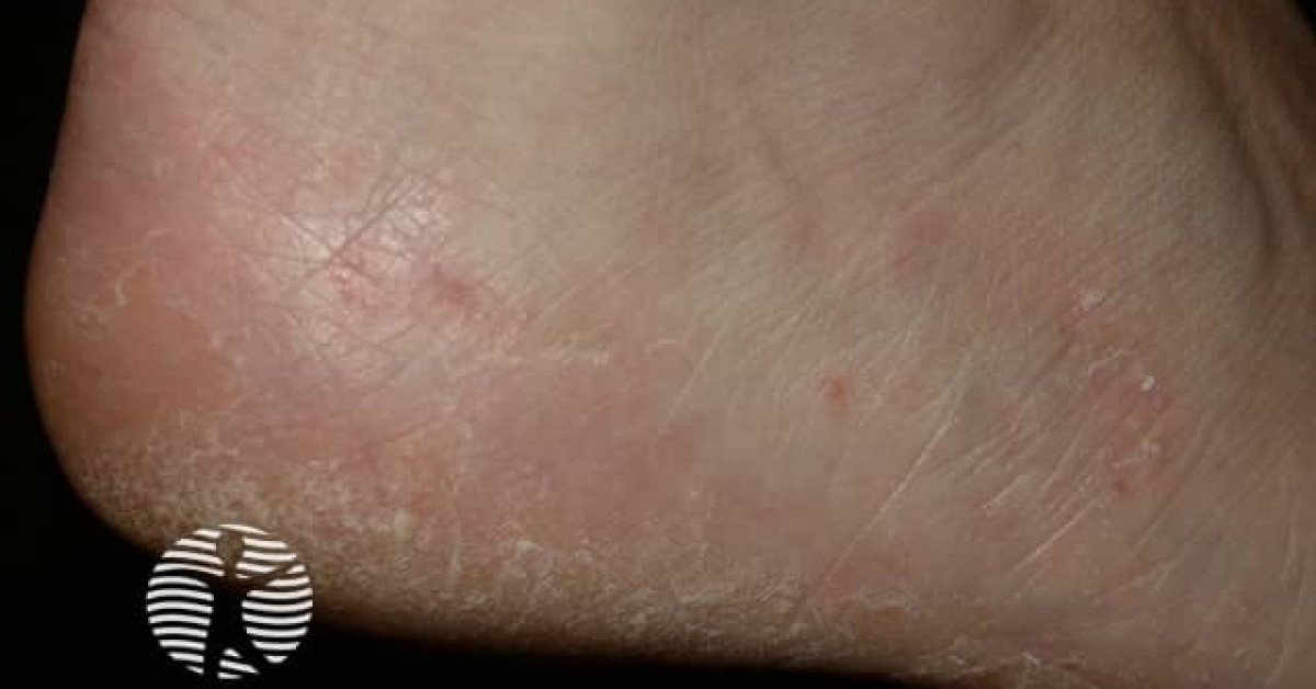 Tinea Pedis Image