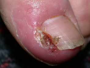 Ingrown toenail