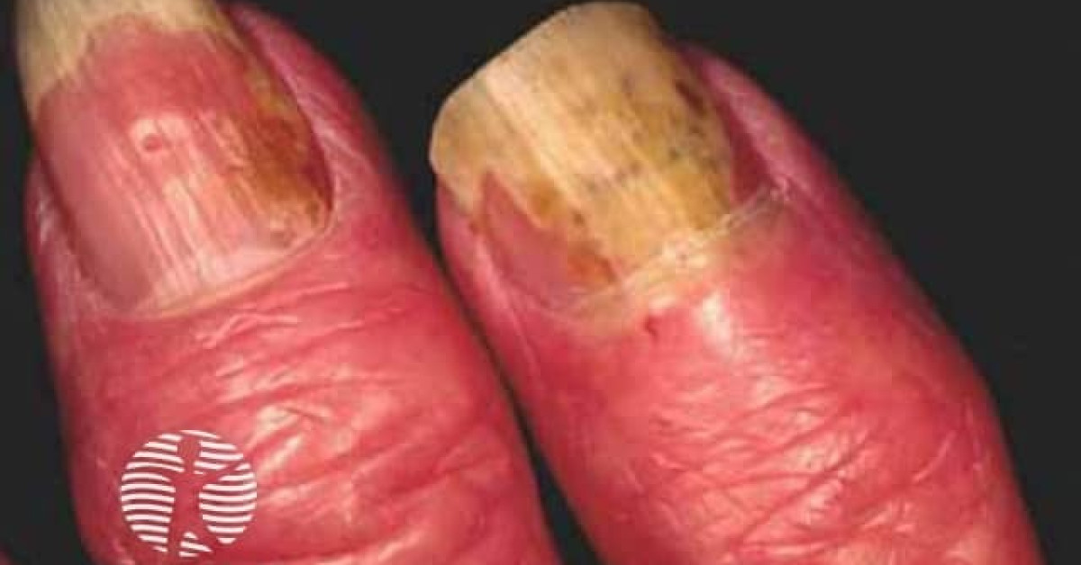 Dermnet Nail Psoriasis Image