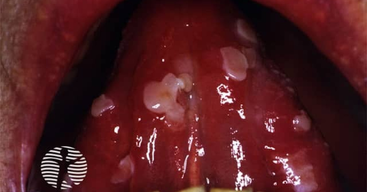 Oral Pemphigus Vulgaris Image