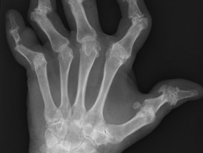 X-ray of left hand affected by psoriatic arthritis