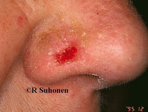 Basal cell carcinoma affecting the nose