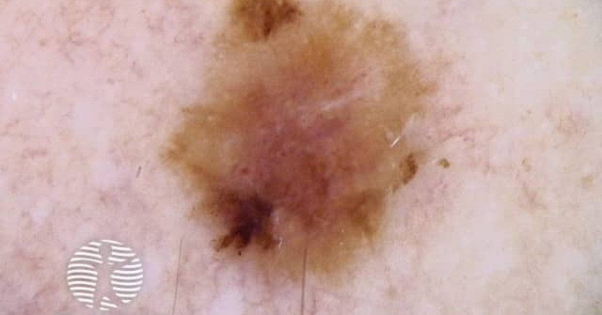 Dermnet Superficial Spreading Melanoma Dermoscopy In Teenager Image