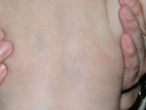 Lumbosacral dermal melanocytosis. Mongolian spots.