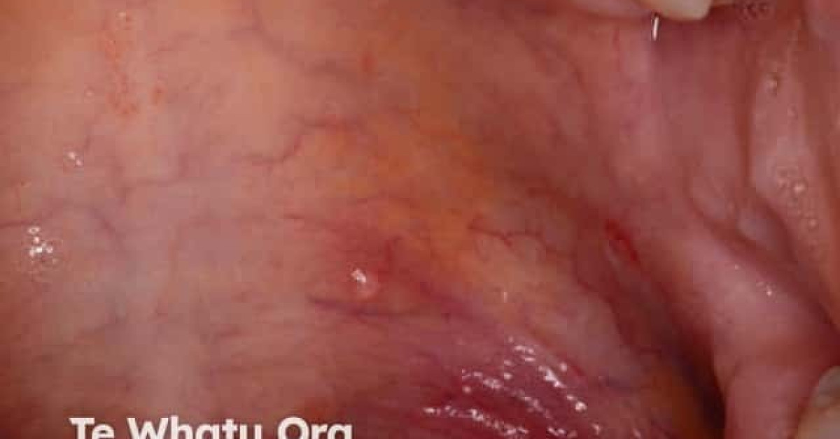 Oral Pemphigus Vulgaris Image