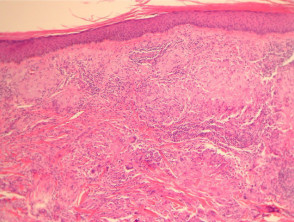 Actinic granuloma  pathology