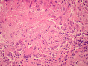 Actinic granuloma  pathology