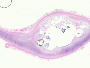 Auricle pseudocyst pathology