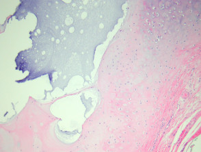 Auricle pseudocyst pathology