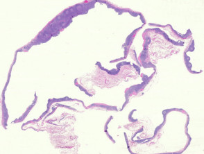 Branchial cleft cyst pathology
