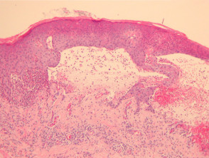 Bullous pemphigoid pathology