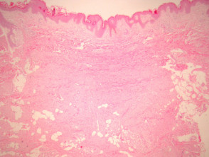 Dermatomyofibroma pathology