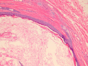 Dermoid cyst pathology