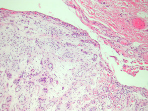 Eccrine mixed tumour pathology
