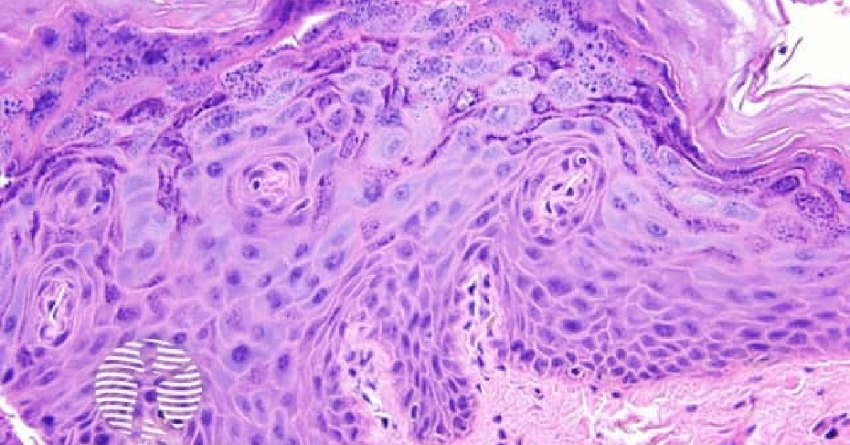 DermNet Epidermodysplasia Verruciformis Pathology Image