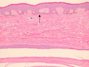 Epidermoid cyst pathology