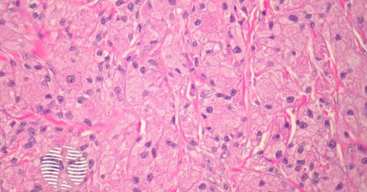 DermNet Granular Cell Tumour Pathology Image