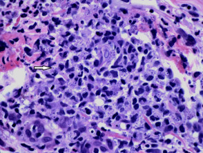 Histoplasmosis  pathology